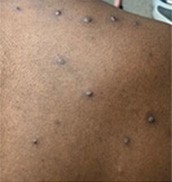 Monkeypox lesions on body