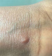Monkeypox lesion on wrist