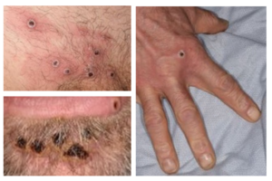 Monkeypox Lesions on different body parts