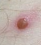 Monkeypox lesion on skin